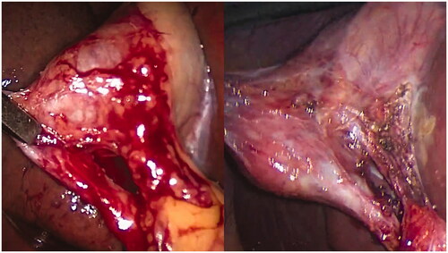 Figure 1. Comparison of two different views of the hepatocystic triangle illustrating different levels of dissection that can be performed in attempting to obtain a critical view of safety.