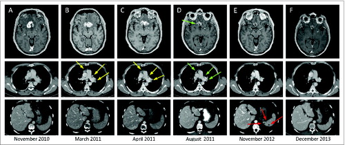 Figure 1. Sarcoidoisis-like lesions occurring in melanoma cancer patient following ipilumumab therapy. Horizontal sections of the brain with melanoma metastatic tumor imaged by magnetic resonance imaging (MRI) and horizontal sections of thorax and abdomen by computed tomography (CT); red arrows indicate isolated sarcoidosis-like granulomas; yellow arrows indicate metastases in the right lung and mediastinum; green arrows indicate residual metastatic burden. Longitudinal imaging: (A) November 2010, pre-ipilimumab; (B) March 2011, after 4 courses of ipilimumab; (C) April 2011, 6 weeks after Ipilimumab; (D) August 2011, 5 months after ipilimumab; (E) November 2012, 20 months after ipilimumab and (F) December 2013, 2 y and 10 months after ipilimumab.