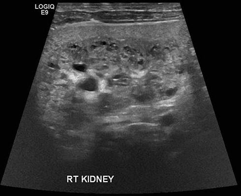 Figure 5 Right kidney (5.4 x 2.2 cm) with multiple small cortical cysts during follow up.