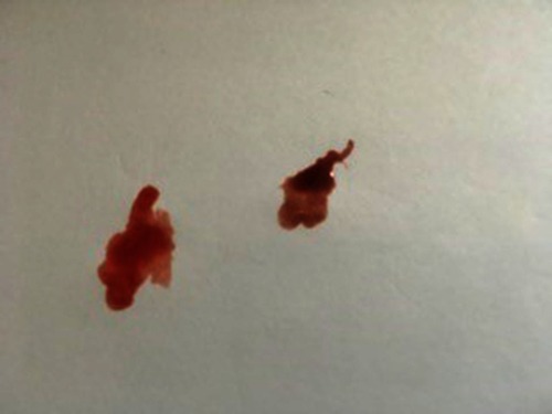 Figure 1 A drop of blood from a control canine patient (left) with a drop from the affected patient. The gross appearance of the blood from the affected patient is the chocolate brown coloration consistent with methemoglobinemia.