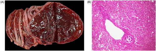 Figure 2. Autopsy results. (A) Liver with diffuse softening, congestion and homogeneous dark red-brown cut surface and (B) confluent liver necrosis/autolysis with parenchymal collapse and mild fatty changes.