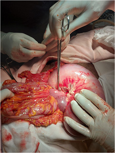 Figure 2 Intraoperative picture of the intussusception.