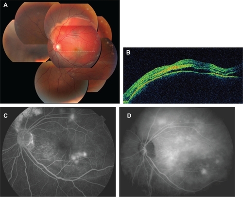 Figure 1 Patient with a choroidal osteoma and choroidal neovascularization before treatment. (A) Fundus photograph showing 5-disc-diameter hemorrhage under the retinal pigment epithelium. (B) Horizontal optical coherence tomographic image, showing pigment epithelial detachment and serous retinal detachment. (C, D) Angiography: fluorescein angiography (C) and indocyanine angiography (D) show several points of dye leakage around the fovea.
