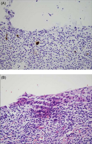 Figure 2. (A) CMV inclusion bodies (black arrow) are stained immunohistochemically with CMV antibody (×200). (B) CMV inclusion bodies (arrows) are seen in the nuclei of endothelial cells (H&E, ×200).