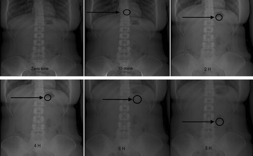 Figure 6. X-ray images of the ORS (BaSO4-loaded) representing its location in the abdomen of a human volunteer at different time intervals (hours).Note: The location of the ORS is represented with an arrow.
