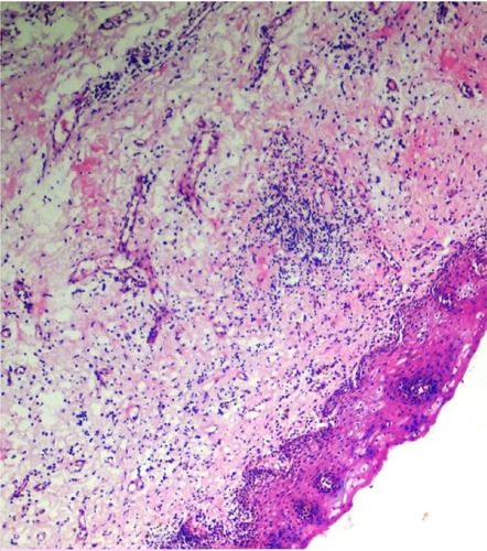 Figure 9 Histopathological picture showing initial stage of oral submucous fibrosis.