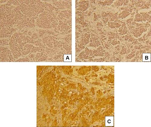 Figure 2 (A) Intranuclear diffuse staining of the tumour cells with ER in a case of IDC-NST (IHC staining, x40), (B) Intranuclear diffuse staining of the tumour cells with PR in a case of IDC-NST (IHC staining, x40), (C) Complete nuclear membrane staining of the tumour cells with HER2 protein in a case of IDC-NST (IHC staining, x40).