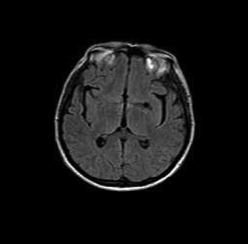 Figure 2. Cranial MR findings in the patient were normal.