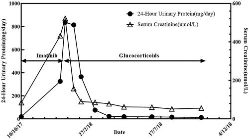 Figure 2. Significant increase in proteinuria and creatinine during imatinib treatment (arrows). The rapid decrease in proteinuria and creatinine after the stop of imatinib and use of glucocorticoids (arrows).