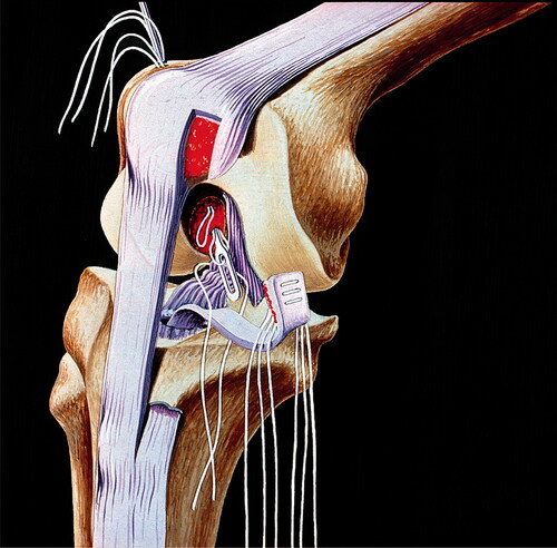 Figure 2. Schematic illustration of how the drill channel through the tibia was designed and how the tendon was drawn through it. Courtesy Ejnar Eriksson, MD.