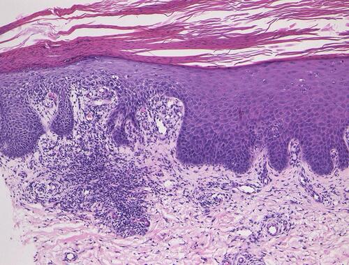 Figure 3 Histopathological features of psoriasiform eruption showing parakeratosis, partially irregular acanthosis of the epidermis, and infiltration of mononuclear cells below the epidermis.