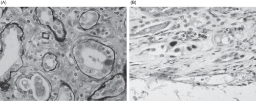 Figure 5. Graft renal biopsy of a patient with typical PVAN. (A) The presence of intranuclear basophilic viral inclusion body in tubular epithelial cell. H&E ×400. (B) Immunohistochemical staining was positive for large T antigen of BKV. ×200.