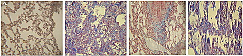 Figure 3. Masson’s trichrome staining in the lung tissue sections. (A) Sections in the group receiving PBS (the negative control) in which collagen fibers (blue) are not seen. (B) Sections for the group receiving bleomycin in which collagen deposition is seen. (C) Sections for the group receiving the aqueous extract of licorice in which collagen deposition decreased compared to the group receiving bleomycin. (D) Sections for the group receiving hydroalcoholic extract of licorice in which an abundance of the collagen deposition is seen. Magnification 400×.