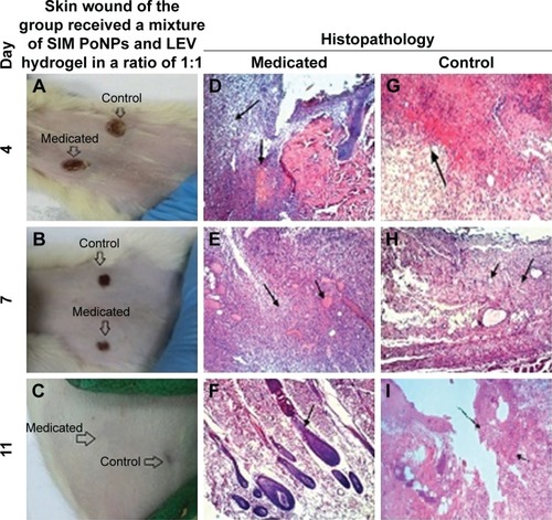 Figure 11 Skin wound and histopathology of the group received a mixture of SIM PoNPs and LEV hydrogel at a ratio of 1:1.