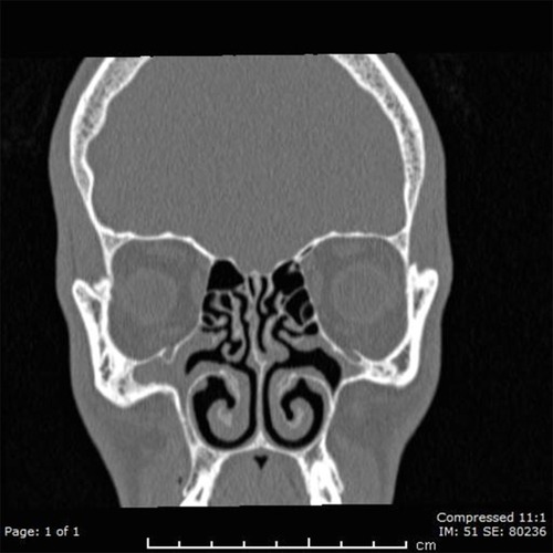 Figure 3 Paranasal CT scan indicated bilateral accessory ostia with sinusitis.