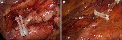 Figure 1 (A) High-tie, the IMA is ligated at its origin within 1 cm from the aorta, with dissection of the apical lymph nodes (LN); (B) Low-tie, the IMA and the proximal left colic artery (LCA) are skeletonized, LCA is preserved, the superior rectal artery (SRA) is ligated, LN dissection medially along the IMA root, including the abdominal aortic (AA) plane.