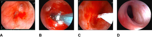 Figure 2 Bronchoscopy images of the left main bronchus stenosis before and after treatment. (A) Scarring stenosis of the left mainstem bronchus, (B) Balloon dilation procedure, (C) Cryoablation post dilation to reduce restenosis, (D) Obvious improvement in the patency of the left mainstem bronchus as shown in post-treatment follow-up examinations.