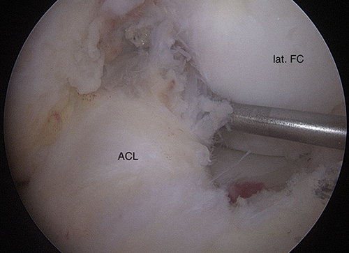 Figure 6 Arthroscopy, notch; anatomically reducted ACL.