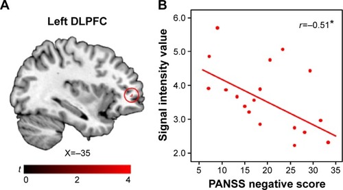 Figure 2 Correlation between GM volume of the left DLPFC and PANSS negative score in patients.