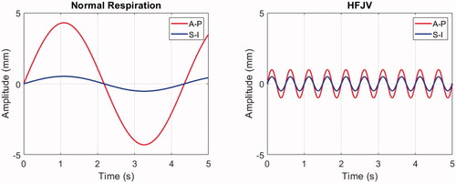 Figure 5. Respiratory-induced pancreas displacement profiles for normal respiration (left) and HFJV (right) in a 5.0 s interval. Anterior-posterior (A-P) and Superior-Inferior (S-I) components are shown in red and blue, respectively. No lateral displacements were included in the respiratory motion simulations.