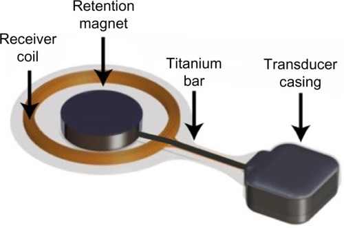 Figure 2 Illustration of how the retention magnet in the implant is further fixed to the transducer casing by a titanium bar.
