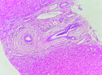 Figure 1. Concentric lamellar fibrosis around the bile ducts; hematoxylin-eosin ×40.