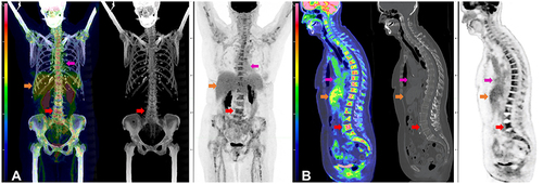 Figure 5 FDG PET-CT of Case #2 After Cycle 1 of R-CHOP. Composite FDG PET-CT images of case #2 after cycle 1 of R-CHOP chemotherapy. Coronal view of fused FDG PET-CT MIP, CT, and PET (A) and sagittal fused FDG PET-CT, CT, and PET (B) demonstrates moderate intense FDG accumulation in the bone marrow of the axial and appendicular skeleton without a specific focus of FDG accumulation nor lytic or sclerotic lesions on CT. Reference L4 vertebral body SUVmax of 5.9 (red arrow). Physiologic FDG accumulation is seen in the liver (Orange arrow) and blood pool (magenta arrow) and spleen. No hypermetabolic lymph nodes or other soft tissue to suggest lymphomatous involvement.