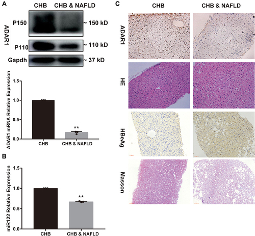Figure 1 Expression levels of ADAR1, miR-122 in livers of CHB concurrent NAFLD patients. (A) The mRNA and protein levels of ADAR1 in liver tissues, (B) The miR-122 level in liver tissues, (C) HE, Masson, and immunohistochemical staining of ADAR1 and HBeAg in liver tissues (magnification × 200). Bars represent the mean ± SD of triplicate repetitions. **P < 0.01.