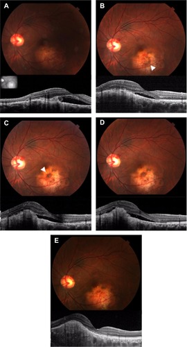 Figure 3 Photograph and spectral domain optical coherence tomography findings for case 1.