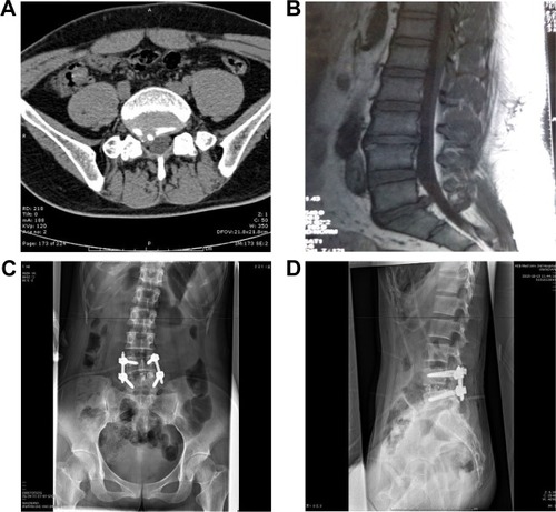 Figure 1 A case of MIS-TLIF surgery.