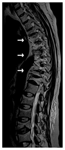 Figure 2 Magnetic resonance imaging showing compression fractures of thoracic vertebral bodies at T4, T7, T10, and T11.