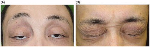 Figure 1. (A, B) Preoperative appearance: marked ptosis and crepey eyelid skin.