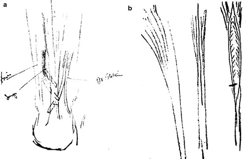 Figure 3. Part of Cushing's operative illustrations documenting the tendon transfer procedures. Case 4. Left: The extensor proprius pollicis and tibialis posterior were sutured to the Achilles tendon. Right: The split tendon method.