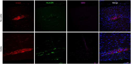Figure 6 Triple immunofluorescence images of proximal colon sections showing α -syn-ir, HLA-DR-ir and CD3-ir in myenteric ganglia of no-colitis (MO2) and colitis (LM1) subjects. Scale bar = 50µm for all panels.