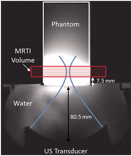 Figure 1. Experimental set-up for FUS sonications in homogeneous gelatin phantoms with real-time volumetric MRTI as shown in an axial T1-weighted MR image. (A) 256-element phased-array transducer is positioned below the phantom cylinder, coupled with room-temperature degassed, deionised water. The geometric focus was placed 19.5 mm into the base of the phantom. The MRTI image slab was oriented perpendicular to the direction of FUS beam propagation, with slices centred at the geometric focus. The base of the MRTI volume was 7.5 mm above the bottom of the phantom.