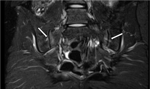 Figure 1 High-intensity signals involving both sacroiliac joints suggestive of bilateral sacroiliitis.