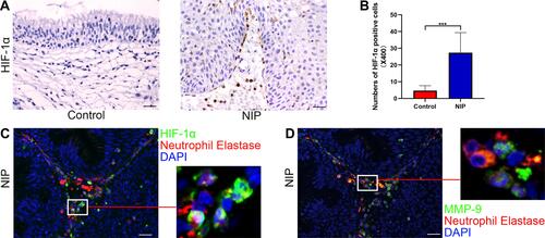 Figure 6 Expression levels of HIF-1α in NIP and its distribution in NIP tissue. (A) immunohistochemical assay of HIF-1α in healthy control (n = 12) and NIP tissue (n = 14), representative images were shown with the magnification of ×400 (scale bar = 20μm). (B) HIF-1α positive cell numbers at ×400 magnification from healthy control and NIP tissue. (C and D) co-staining of neutrophil elastase with HIF-1α/MMP-9 in NIP tissue at ×400 magnification (scale bar = 20μm), higher power field was shown on the right side of each image. Data was shown as mean ± SD, Statistical significance was calculated using Student’s t-test, ***p< 0.001.