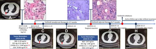 Figure 1 Timeline of the clinical course. Thoracic CT images of the tumor at baseline (A), after neoadjuvant treatment with gefitinib (C and D), and at postoperative follow-up (G and H); Hematoxylin-Eosin stained slide of the core needle biopsy (B), resected primary lesion (E) and resected lymph node (F).