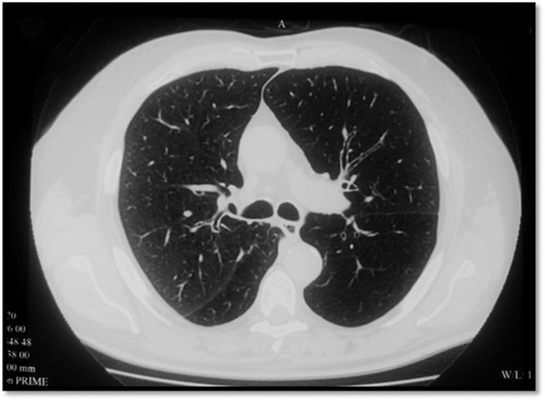 Figure 2 CT of a patient with emphysema with giant bulla.