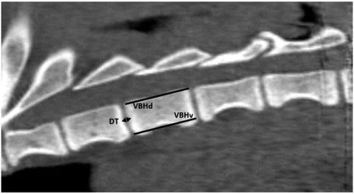 Figure 1. Parameters measured on each vertebrae on the sagittal CT image: vertebral body height at dorsal border (VBHd), vertebral body height at ventral border (VBHv) and disc thickness (DT).