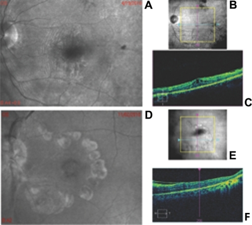 Figure 1 (A) Representative F-10 blue laser imaging of one eye with pre-retinal wrinkling; (B) Infra-red fundus photograph of the same patient showing the position of the scan in image (C); (C) optical coherence tomography scan of the same eye, which shows pre-retinal wrinkling. (D) Representative F-10 blue laser imaging on one eye with macular pucker and macular hole; (E) Infra-red fundus photograph of the same patient showing the position of the scan in image (F); (F) optical coherence tomography of the same eye which shows macular pucker.