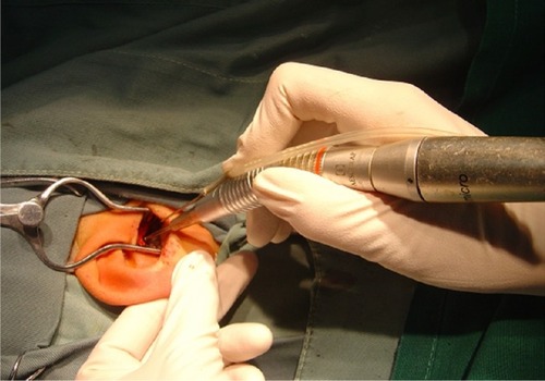 Figure 1 Milling process in otological surgery.