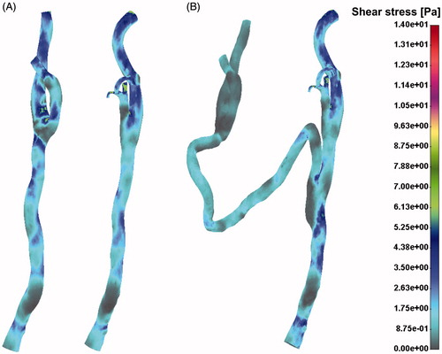 Figure 4. Shear stress distribution field for the pre- (A) and post-operative (B) case.