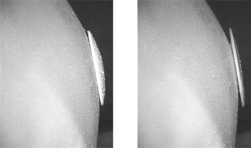 Figure 2 A) Photograph of the skull model showing the newly designed burr-hole buttons filling the burr holes at the tuber frontale, tuber parietale, frontal bone surrounding the linea temporalis and frontal bone 3 cm lateral to the midline. B) Photograph (tangential view) showing the burr-hole button with curvature radius of 30 mm placed in the burr hole defect at the tuber frontale. The border between the button and the surrounding skull model is smooth. C) Photograph (tangential view) showing the conventional burr-hole button placed in the burr hole defect at the tuber frontale. The border between the button and the surrounding skull model is irregular.