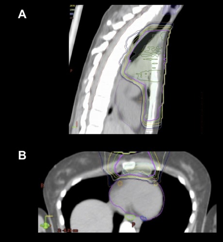 Figure 4 When the target spans down in front of the heart, protons can be very useful. (A) Sagittal view; (B) axial view.