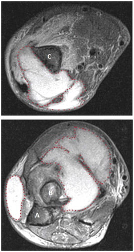 Figure 2. MRI showed a multi-loculated collection at the distal humerus (upper panel) and the proximal radio-ulnar joint (lower panel). Key: A: ulna; B: radius; C: humerus.