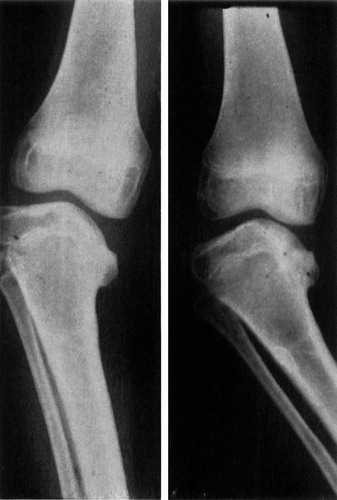 Figure 1 b. Preoperative radiographs, without weight-bearing (left). During weight-bearing (right) varus is increased because the defective medial condyle provides poor support for the femoral condyle. Reprinted from Støren (1969).