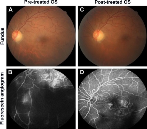 Figure 4 Represents the color fundus photo and fundus fluorescein angiography of the left eye at pre-treatment and post-treatment phases.