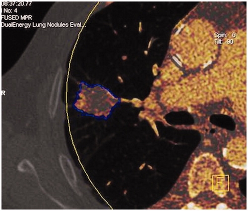 Figure 3. DECT image. Software automatically isolating the entire nodule from the pulmonary parenchyma to determine a volumetric ROI. (a) Diagnostic efficacy of DECT. (b) Example of the evolution of the enhancement in a patient with an early recurrence and in a patient with no recurrence.