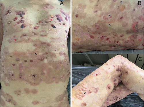 Figure 1 Generalized infiltrative erythema and plaques, tense vesicles and blisters on the trunk and extremities (Red arrows mark some of the typical psoriatic lesions, and black arrows mark the lesions of BP). Blisters basically appear on psoriatic lesions (A). Erosions and crusts mainly observed on his back and legs (B and C).